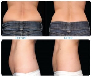 CoolSculpting Before and After