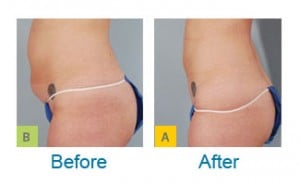 SmartLipo Before and After