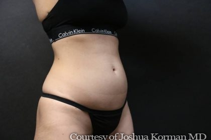 EmSculpt Before & After Patient #5413
