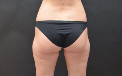 CoolSculpting Before & After Patient #5194
