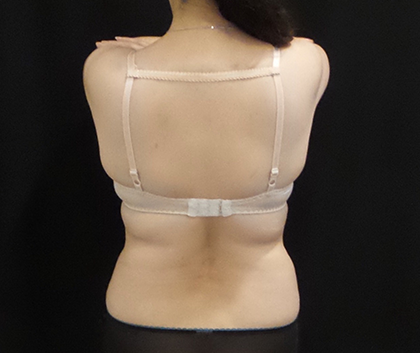 CoolSculpting Before & After Patient #5023