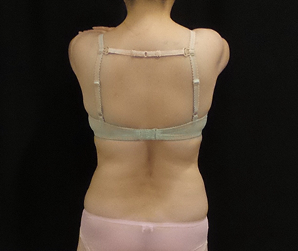 CoolSculpting Before & After Patient #5023
