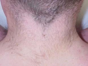Laser Hair Removal Before & After Patient #2419