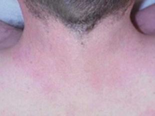 Laser Hair Removal Before & After Patient #2419