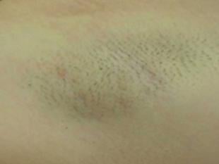 Laser Hair Removal Before & After Patient #2425