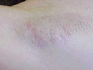 Laser Hair Removal Before & After Patient #2425