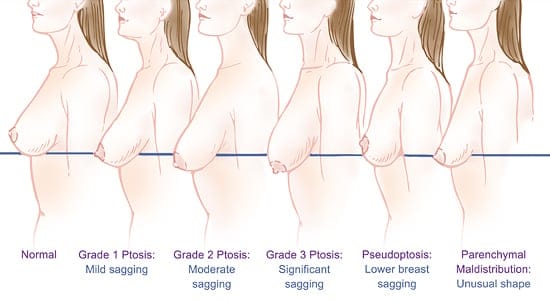 breast lift infographic