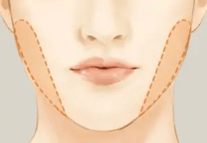 buccal fat removal illustration