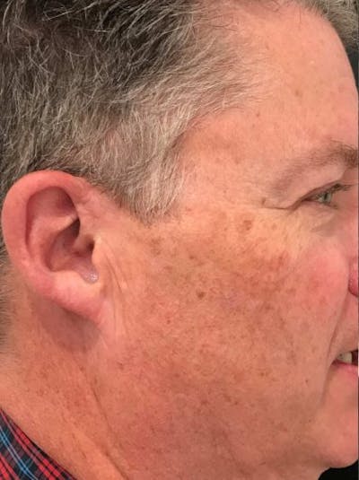 PicoWay Before & After Gallery - Patient 418476 - Image 1