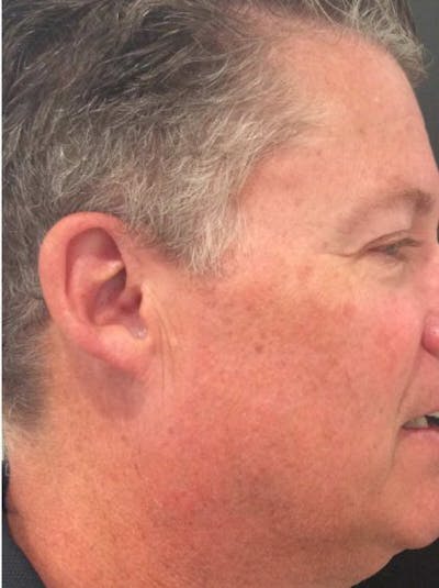 PicoWay Before & After Gallery - Patient 418476 - Image 2