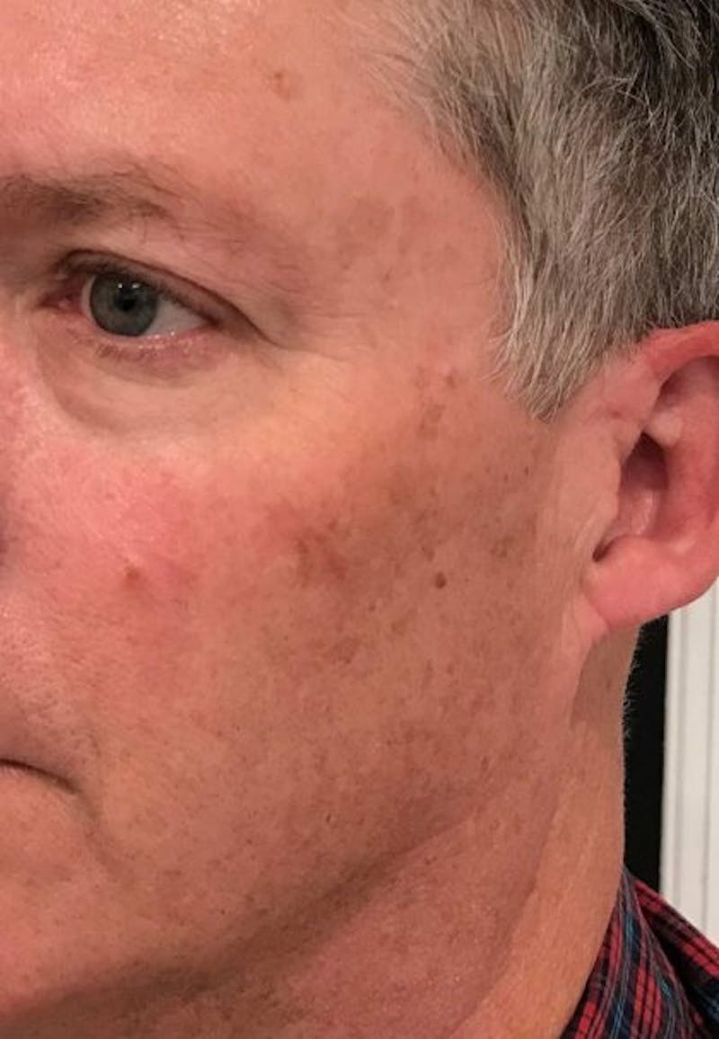 PicoWay Before & After Gallery - Patient 418476 - Image 3