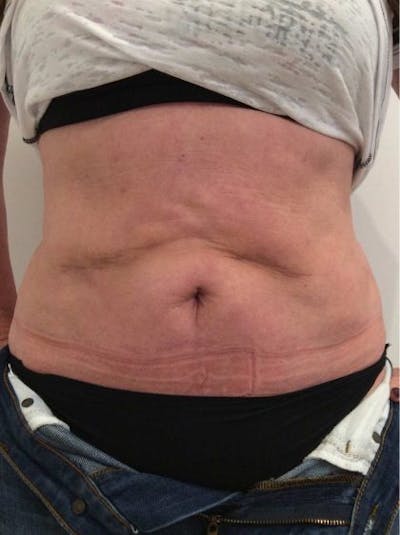 Sculptra Before & After Gallery - Patient 426409 - Image 1