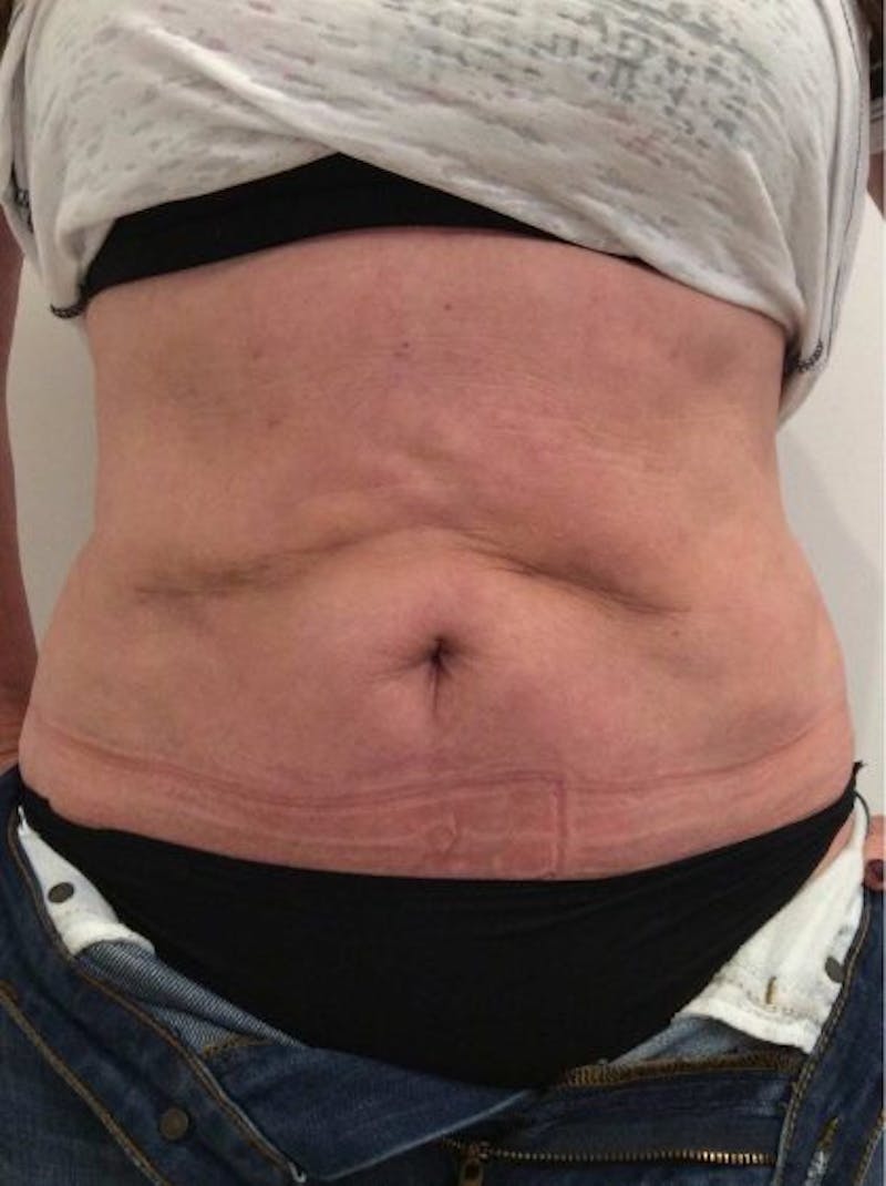 Sculptra Before & After Gallery - Patient 426409 - Image 1