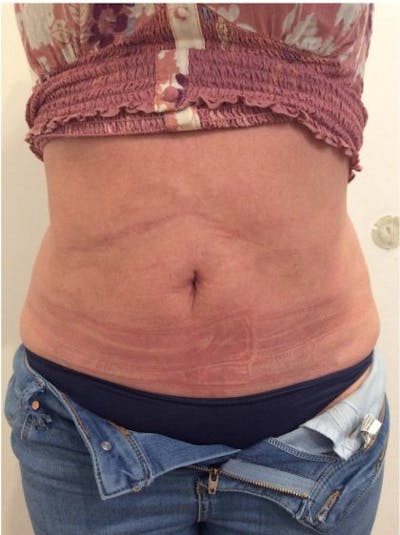Sculptra Before & After Gallery - Patient 426409 - Image 2