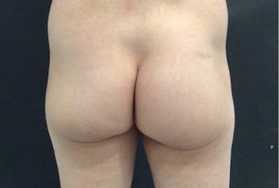 Sculptra Before & After Gallery - Patient 561936 - Image 1