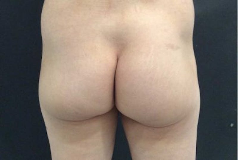 Sculptra Before & After Gallery - Patient 561936 - Image 1