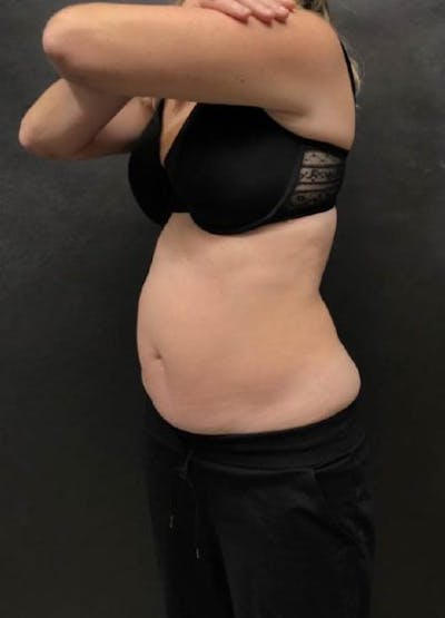 EmSculpt Neo Before & After Gallery - Patient 341455 - Image 1