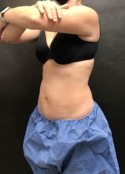 EmSculpt Neo Before & After Gallery - Patient 341455 - Image 2