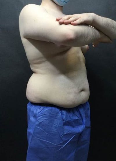 EmSculpt Neo Before & After Gallery - Patient 358526 - Image 1