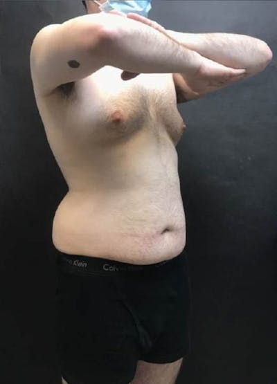 EmSculpt Neo Before & After Gallery - Patient 358526 - Image 2