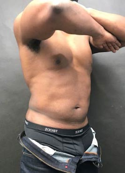 EmSculpt Neo Before & After Gallery - Patient 267149 - Image 1