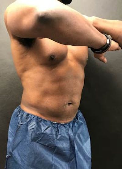 EmSculpt Neo Before & After Gallery - Patient 267149 - Image 2
