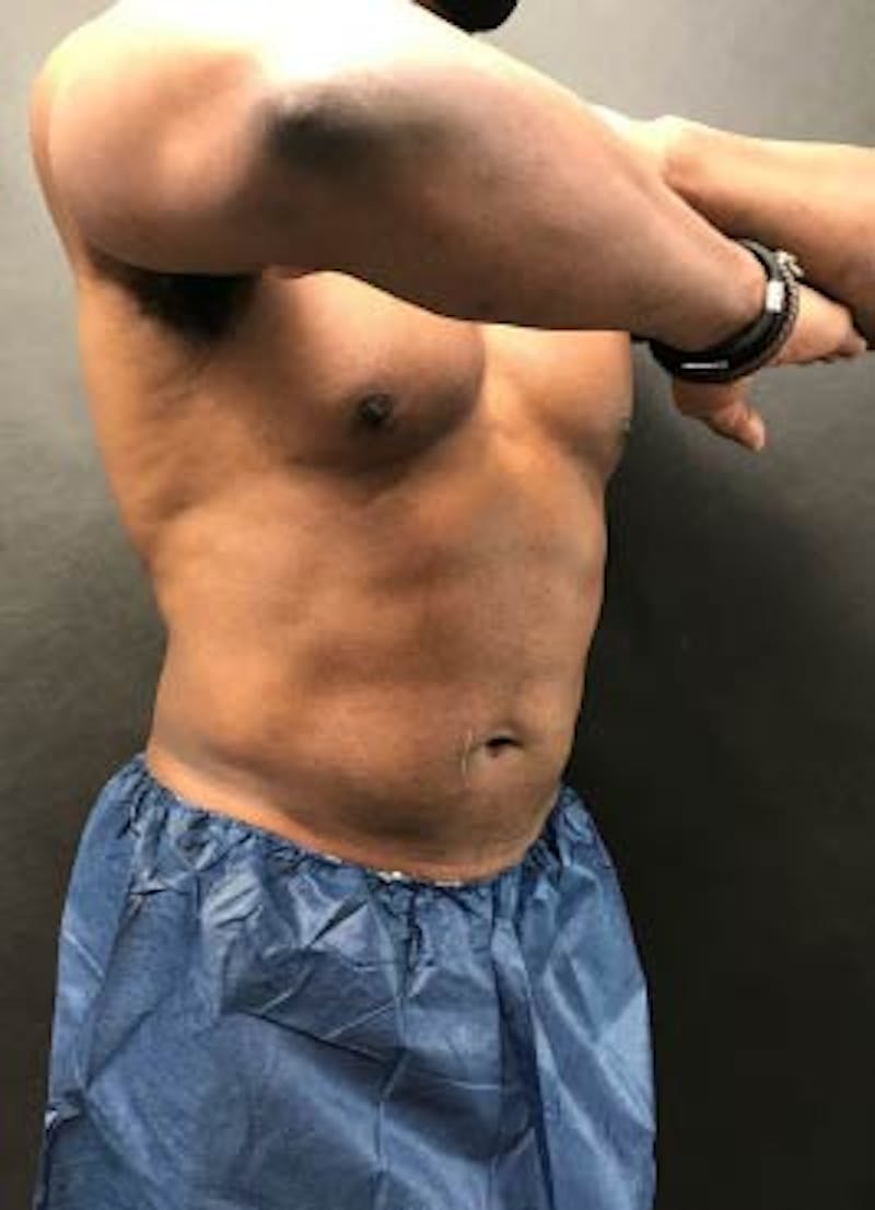 EmSculpt Neo Before & After Gallery - Patient 267149 - Image 2