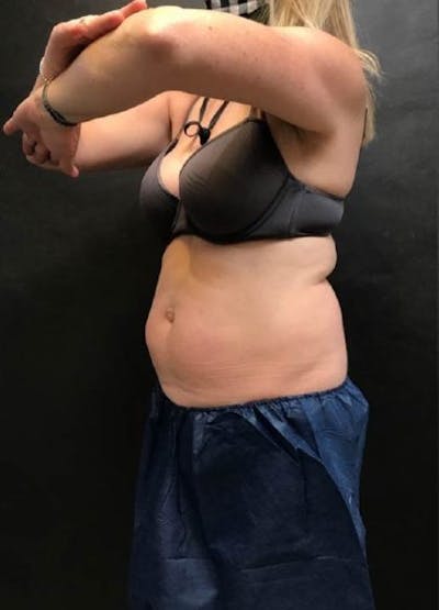 CoolSculpting Before & After Gallery - Patient 162813 - Image 1