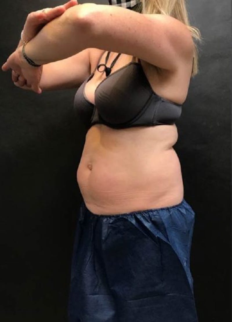 CoolSculpting Before & After Gallery - Patient 162813 - Image 1