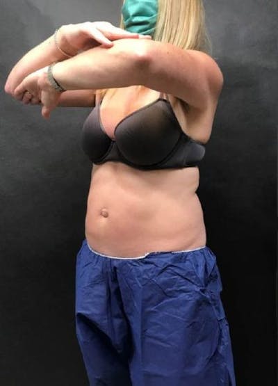 CoolSculpting Before & After Gallery - Patient 162813 - Image 2