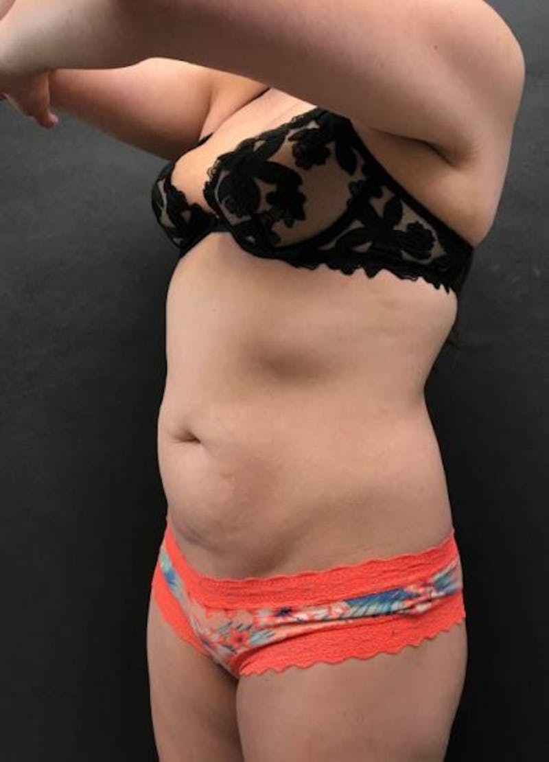 CoolSculpting Before & After Gallery - Patient 174456 - Image 1