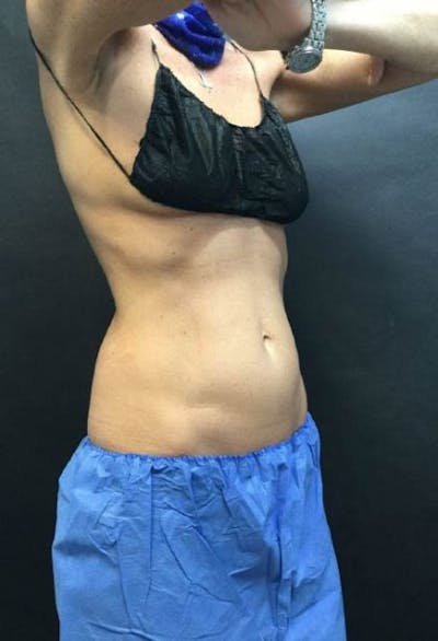 CoolSculpting Before & After Gallery - Patient 279565 - Image 1