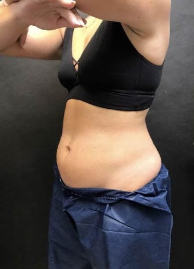 CoolSculpting Before & After Gallery - Patient 971499 - Image 1