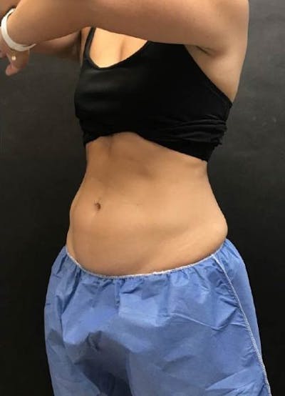 CoolSculpting Before & After Gallery - Patient 971499 - Image 2