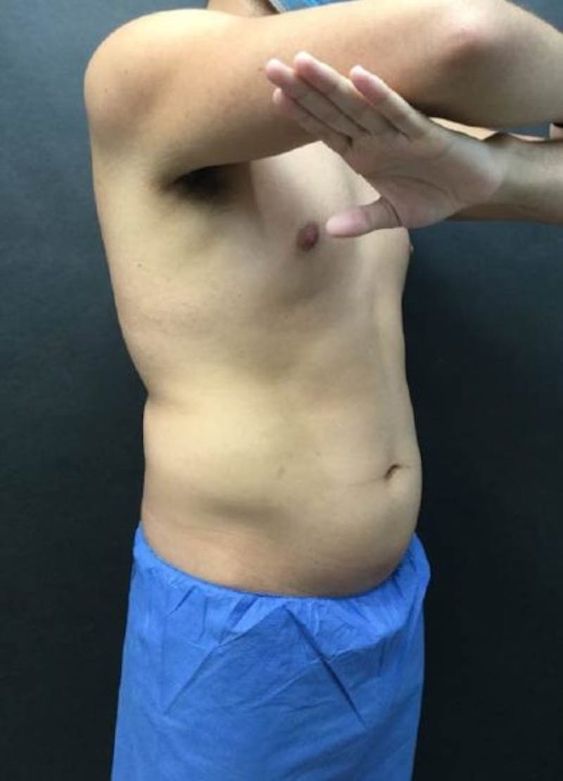 Male CoolSculpting Before & After Gallery - Patient 298220 - Image 1