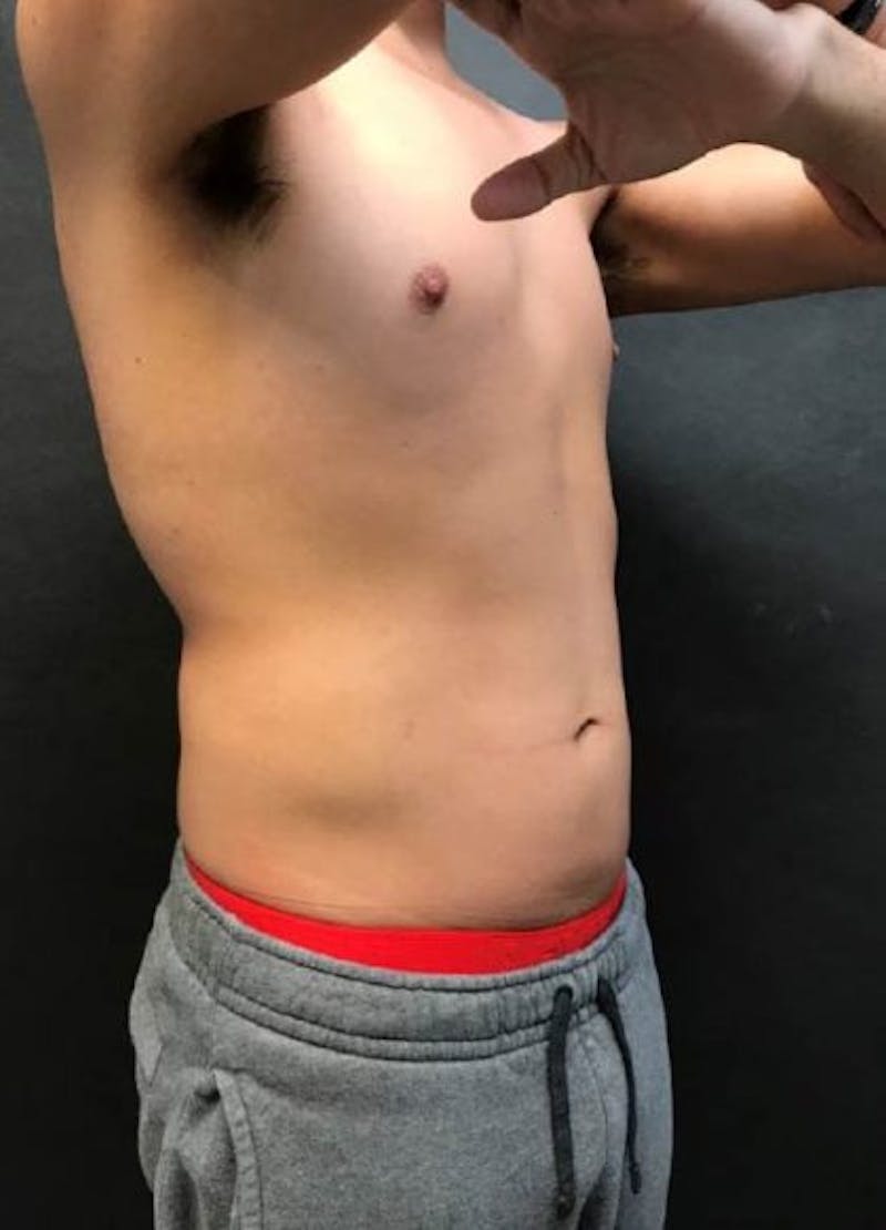 Male CoolSculpting Before & After Gallery - Patient 298220 - Image 2