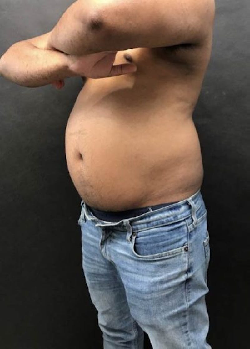 Male CoolSculpting Before & After Gallery - Patient 172489 - Image 1
