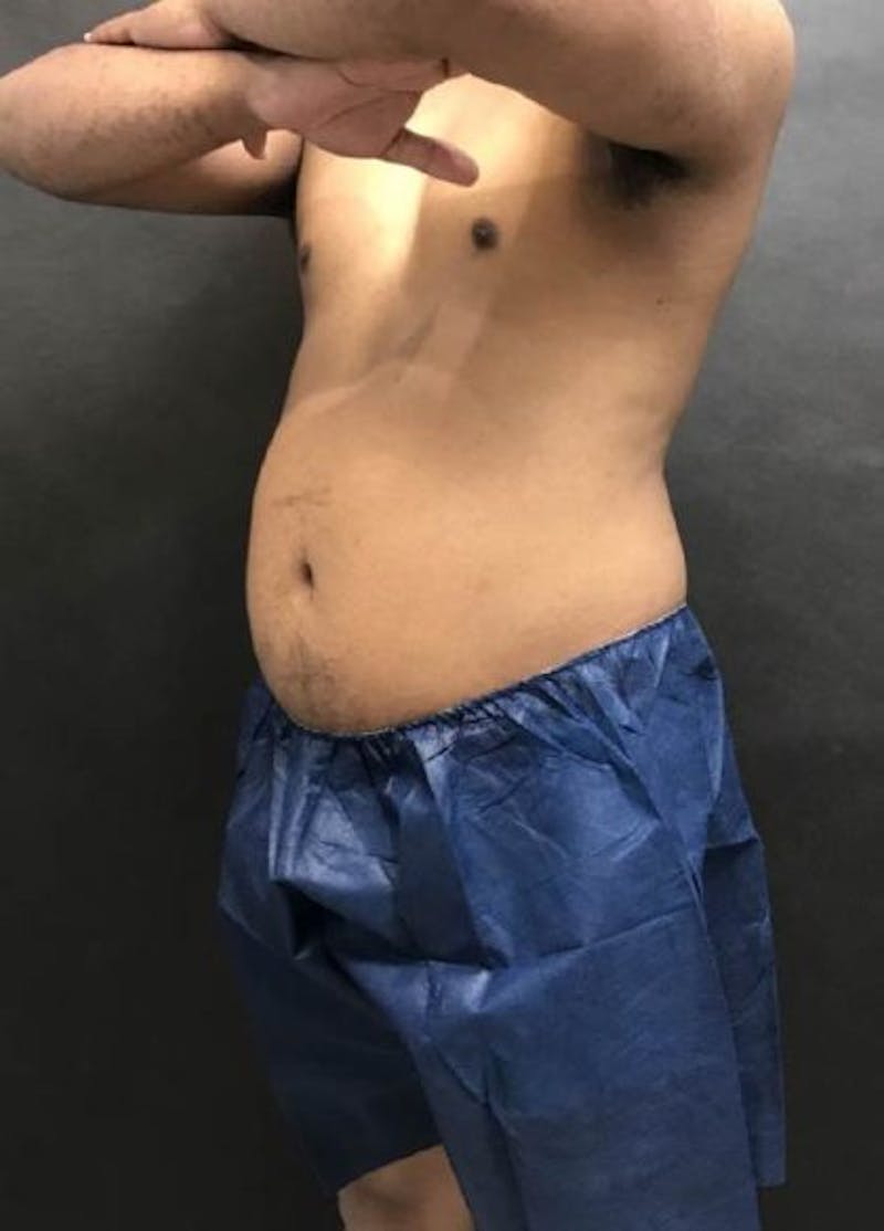 Male CoolSculpting Before & After Gallery - Patient 172489 - Image 2