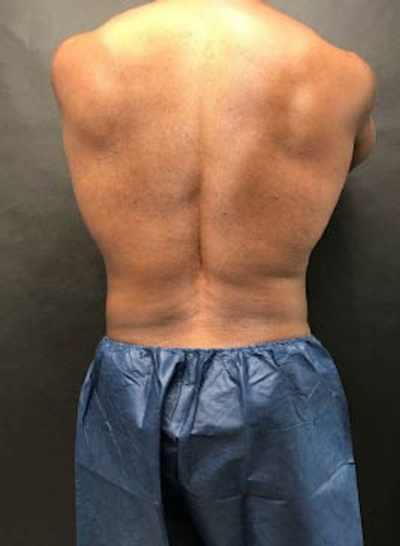 Male CoolSculpting Before & After Gallery - Patient 423007 - Image 4