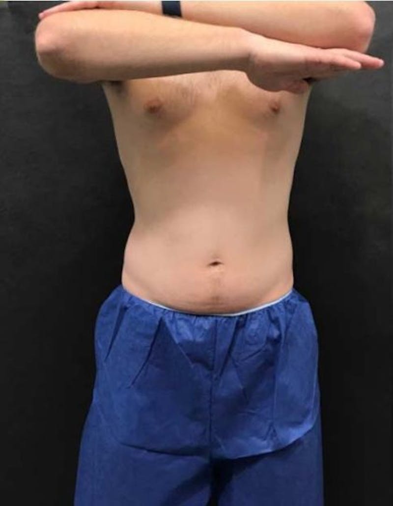Male CoolSculpting Before & After Gallery - Patient 115571 - Image 1