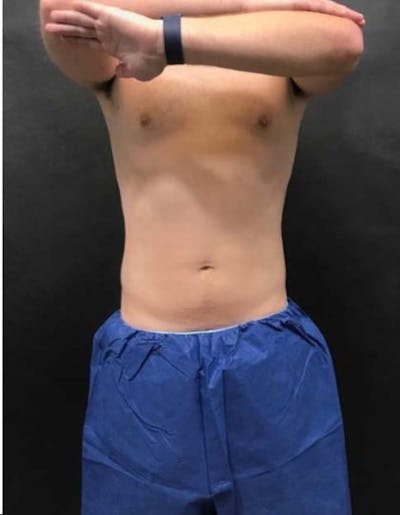 Male CoolSculpting Before & After Gallery - Patient 115571 - Image 2
