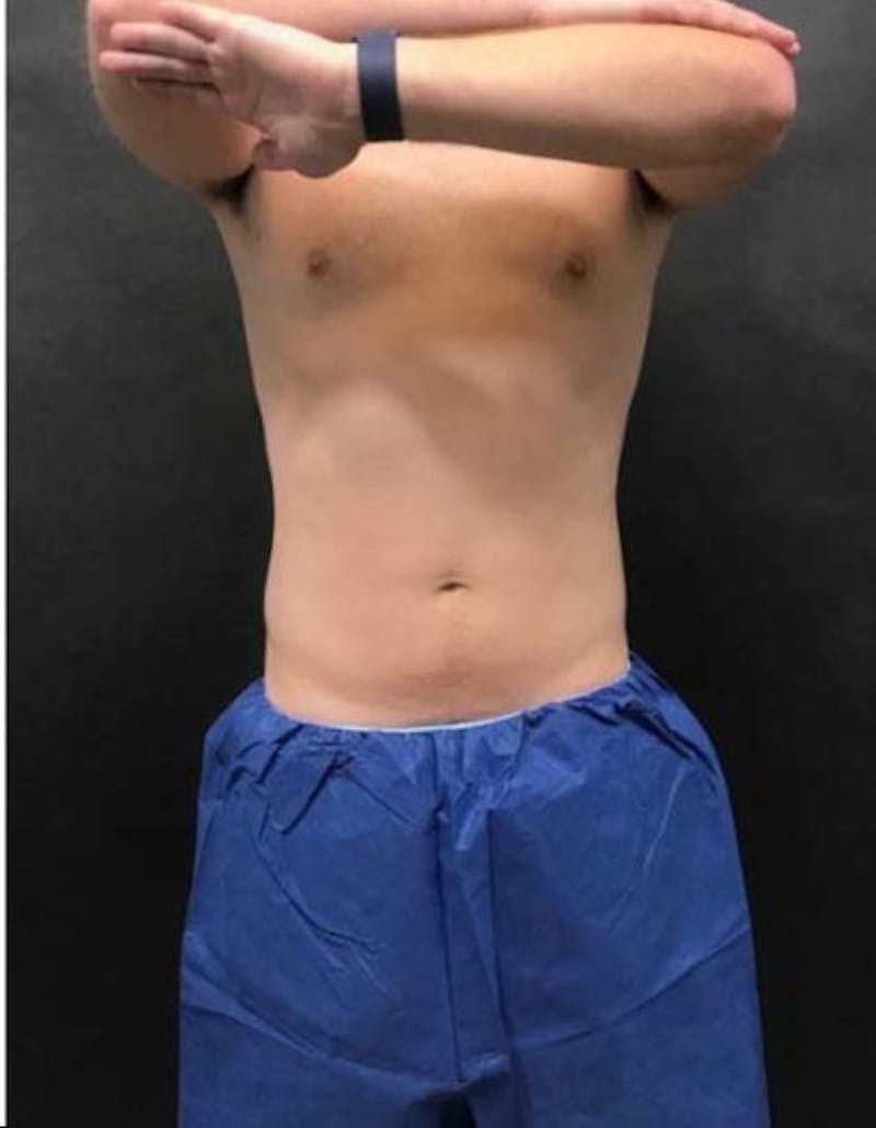 Male CoolSculpting Before & After Gallery - Patient 115571 - Image 2