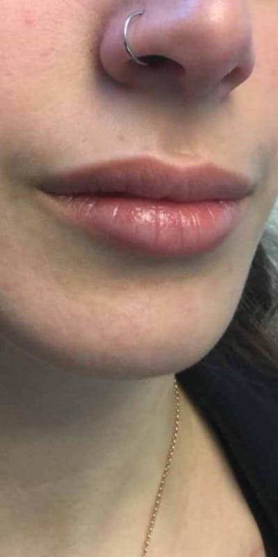 Restylane Before & After Gallery - Patient 676690 - Image 1