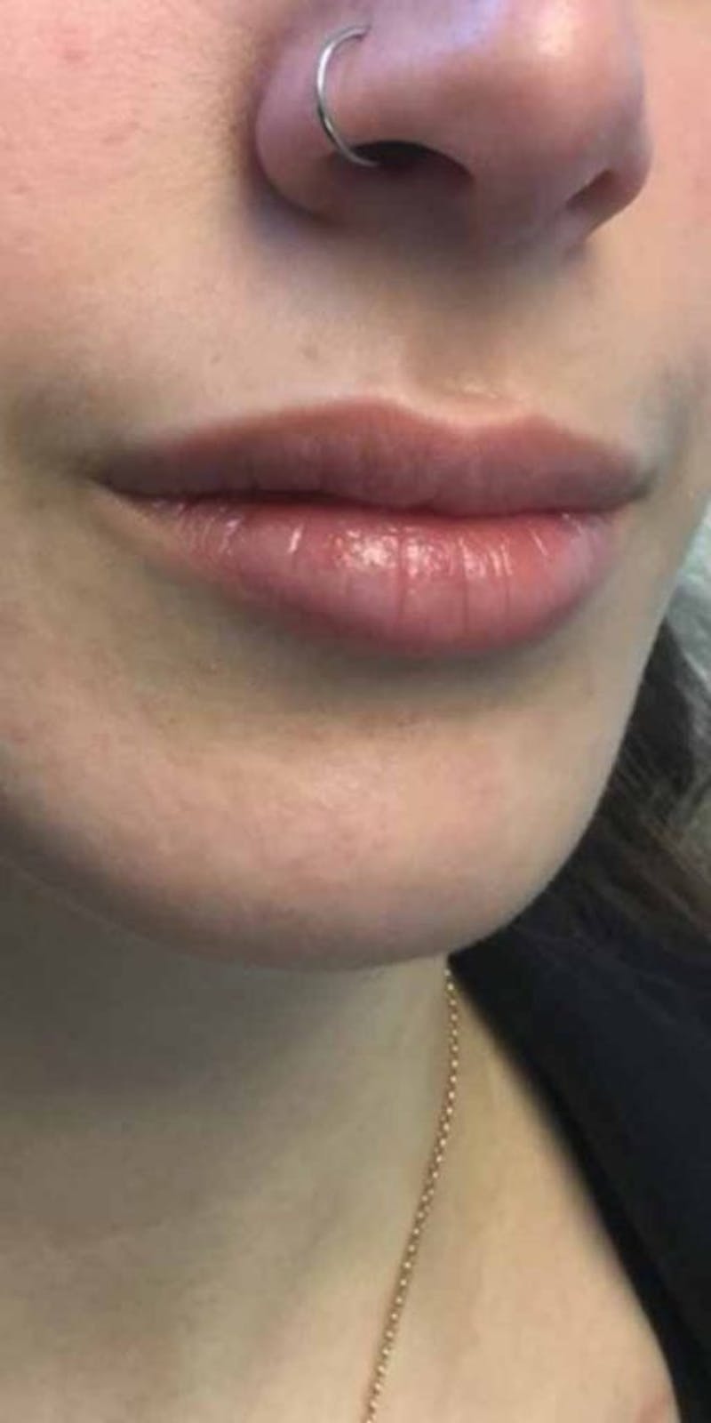 Restylane Before & After Gallery - Patient 676690 - Image 1