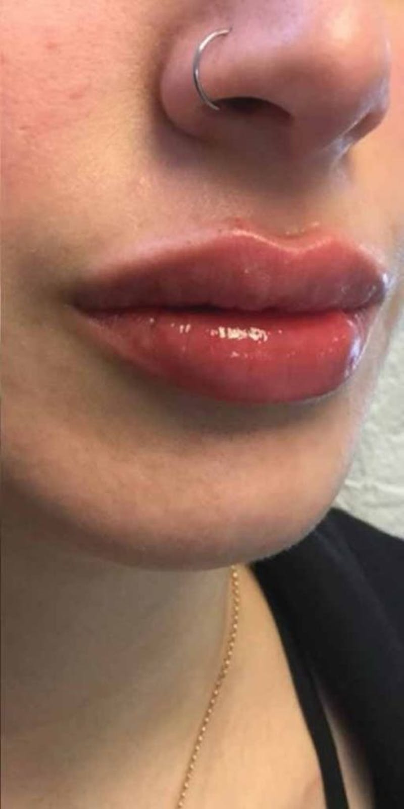 Restylane Before & After Gallery - Patient 676690 - Image 2