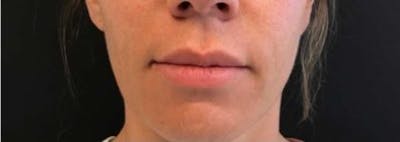 Restylane Before & After Gallery - Patient 340985 - Image 1