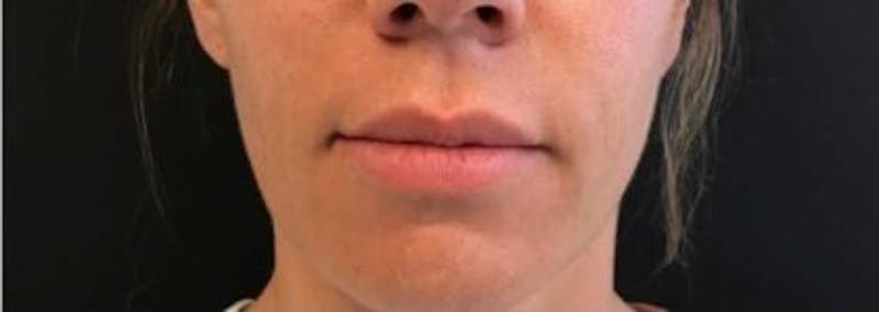 Restylane Before & After Gallery - Patient 340985 - Image 1