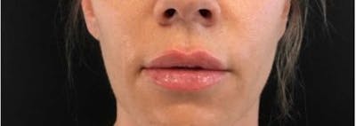 Restylane Before & After Gallery - Patient 340985 - Image 2