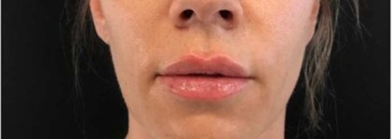 Restylane Before & After Gallery - Patient 340985 - Image 2