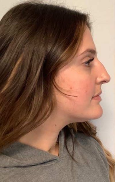 Restylane Before & After Gallery - Patient 131097 - Image 1